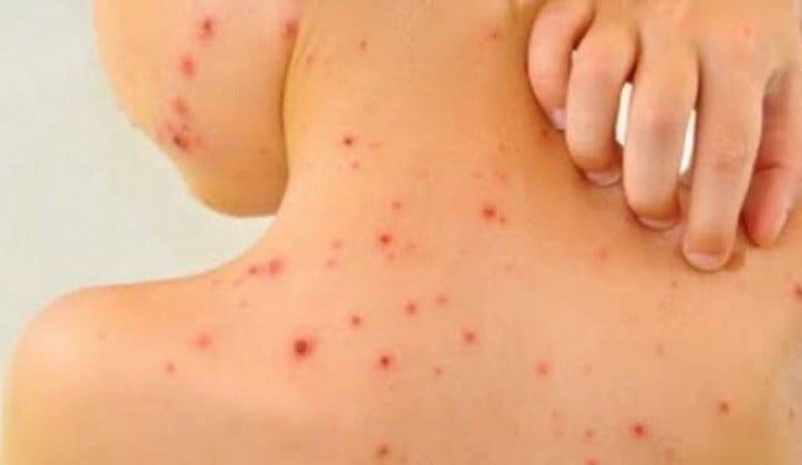 Kaić: Opet možemo imati epidemiju ospica u Hrvatskoj